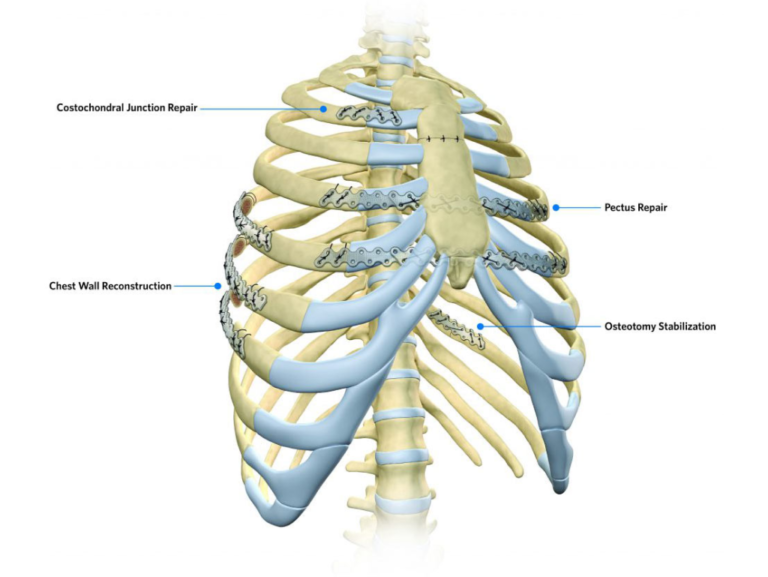 Chest Wall Reconstruction In Abu Dhabi Chest Wall Surgery Abu Dhabi